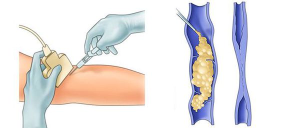 Склеротерапия (склеивание вены специальным препаратом)