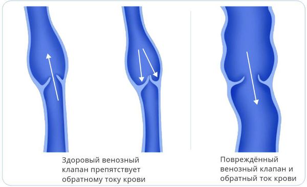 Здоровый и повреждённый клапаны вены