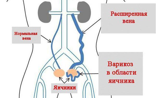 Расширение яичниковой вены