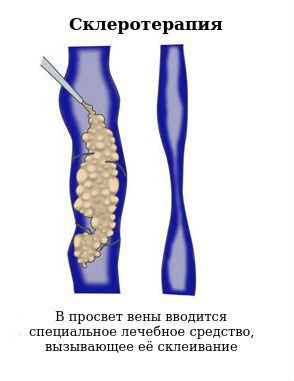 Склеротерапия