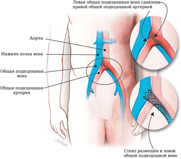 Стентирование подвздошных вен