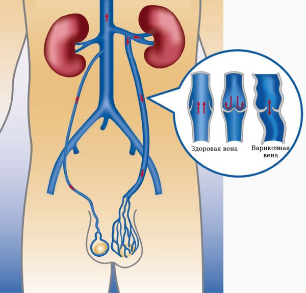 Расширение яичковой вены