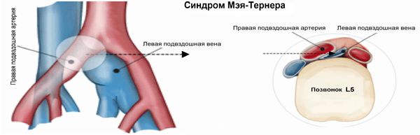 Синдром Мея — Тернера