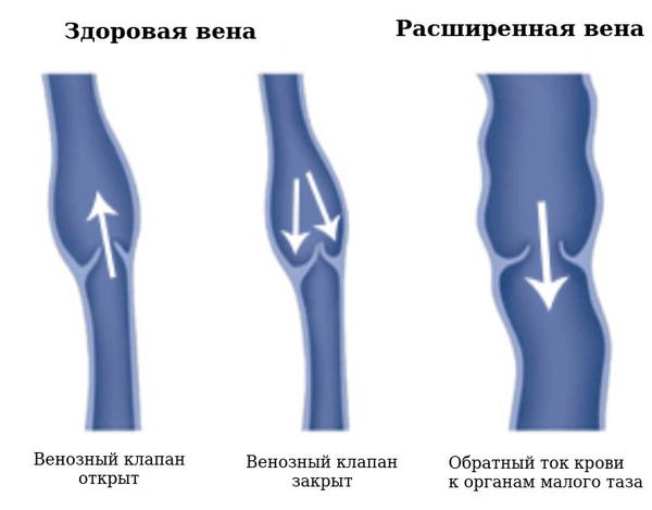 Здоровая и расширенная вены