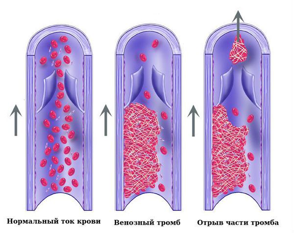 Отрыв части тромба