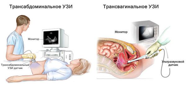 Ультразвуковое исследование малого таза