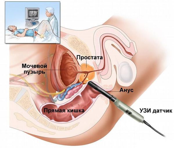 Трансректальное УЗИ предстательной железы