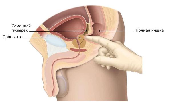 Массаж семенных пузырьков