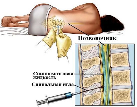 Спинномозговой прокол