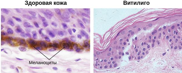 Отсутствие меланоцитов при витилиго