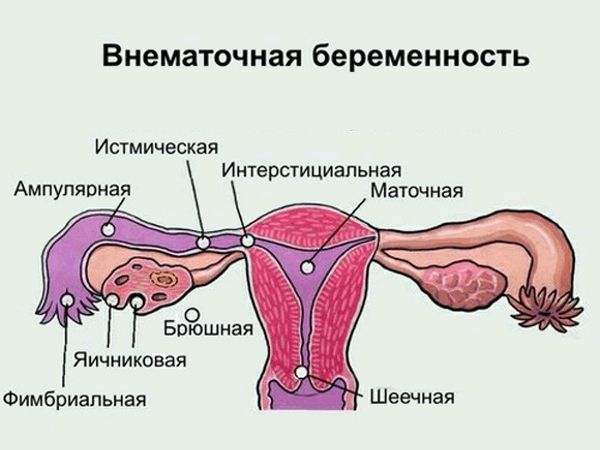 Локализация внематочной беременности