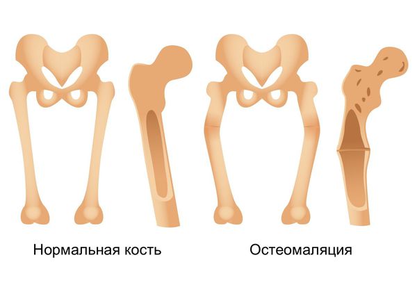 Остемаляция