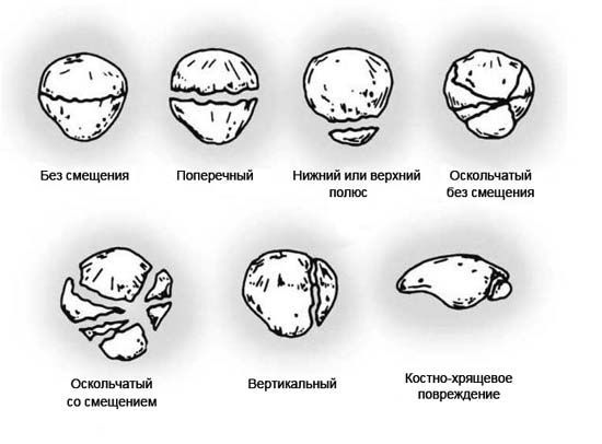 Виды внутрисуставных переломов