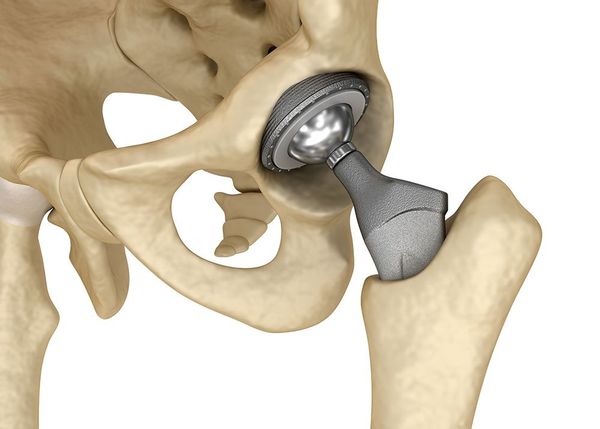 Эндопротез тазобедренного сустава