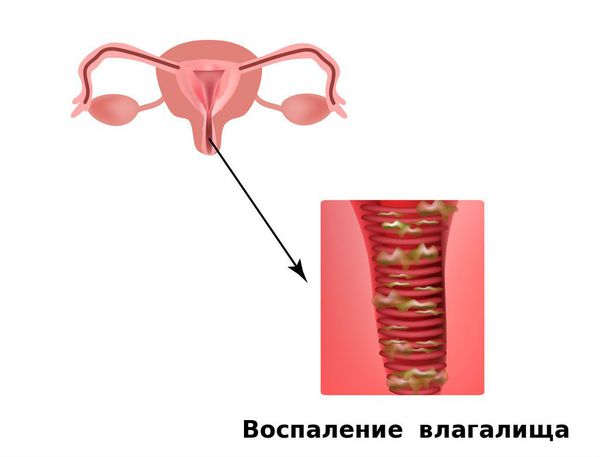 Воспаление влагалища