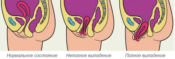 Выпадение влагалища и матки