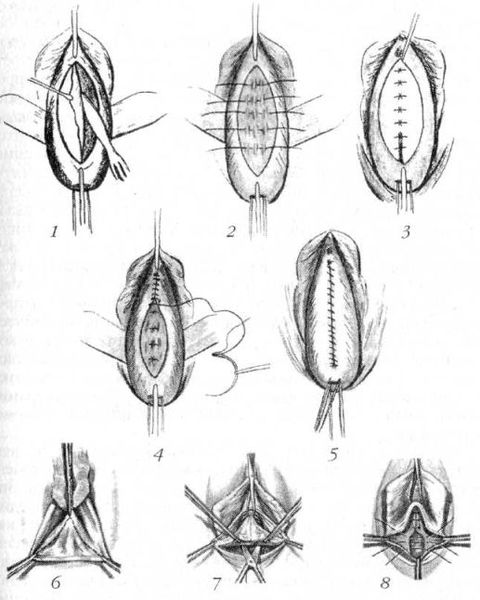 Пластика влагалища и леваторопластика