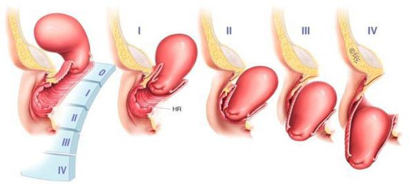 Стадии выпадения влагалища