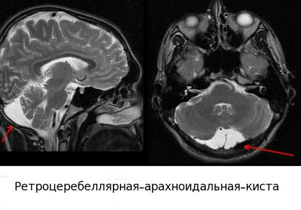 Ретроцеребеллярная киста