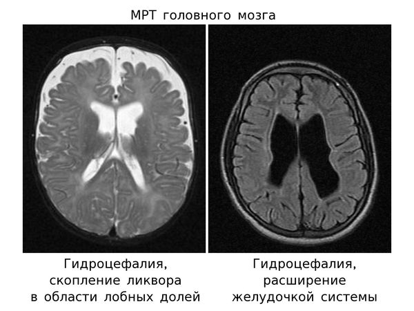 МРТ, гидроцефалия