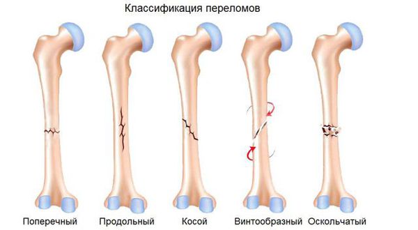 Классификация переломов по форме линии излома