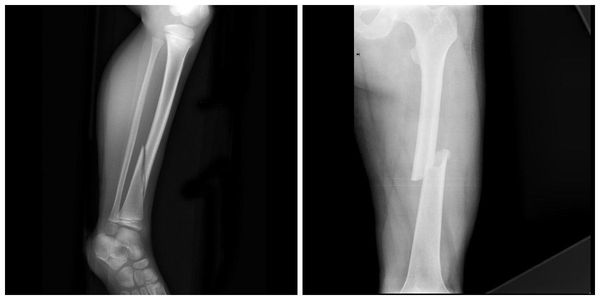 Закрытый перелом на рентгеновском снимке