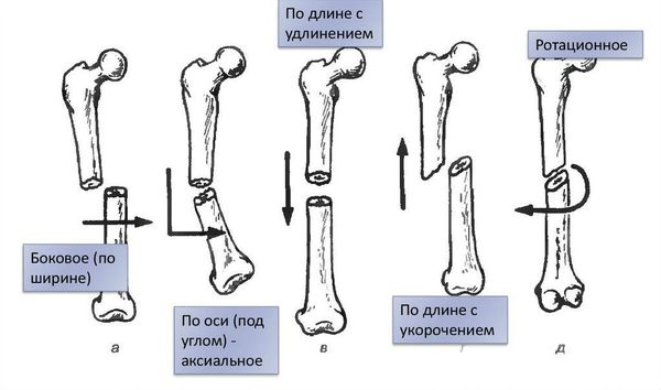 Виды смещения костных отломков