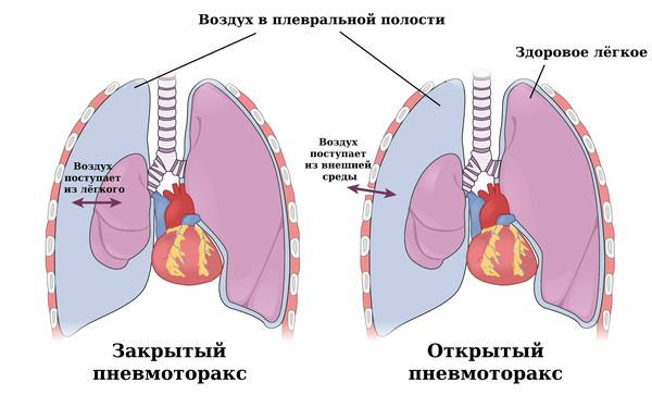 Открытый и закрытый пневмоторакс