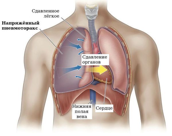 Напряжённый (клапанный) пневмоторакс