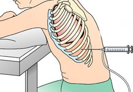 Плевральная пункция