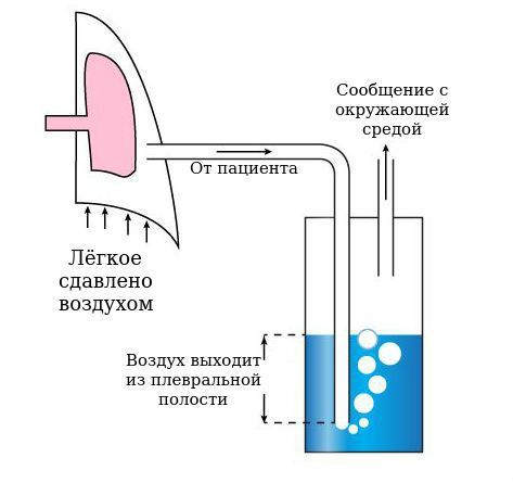 Дренирование плевральной полости