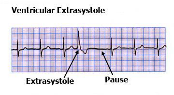 Экстрасистола и компенсаторная пауза