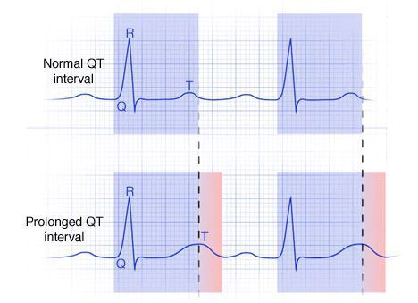 Интервал QT в норме и удлинённый