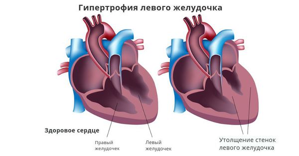 Утолщение стенок левого желудочка