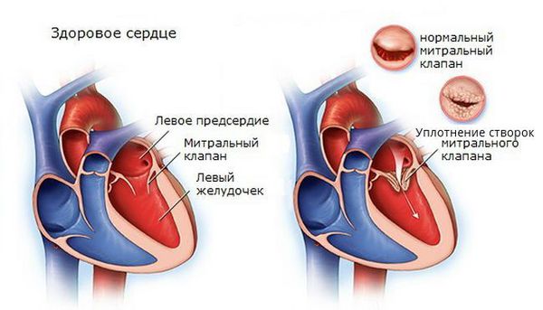 Уплотнение створок митрального клапана