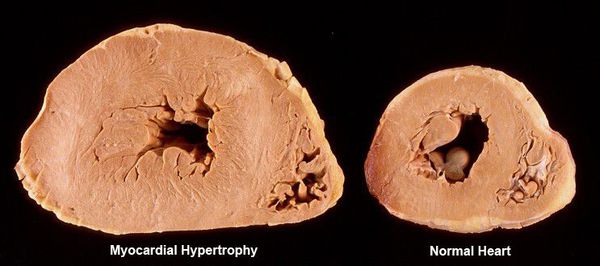 Гипертрофия миокарда