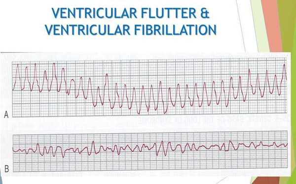 Трепетание и фибрилляция желудочков