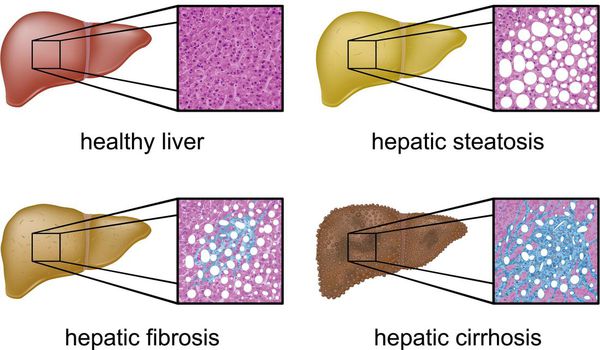 Патологические изменения ткани печени