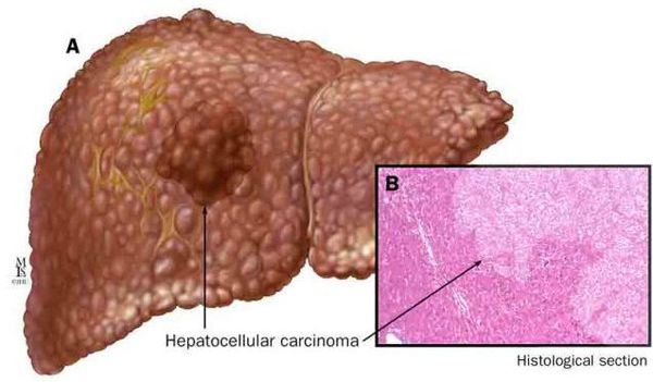 Гепатоцеллюлярная карцинома