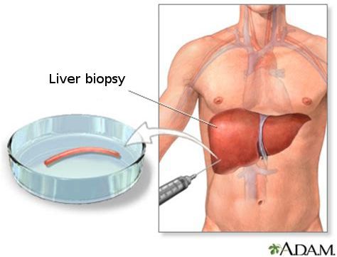 Биопсия печени