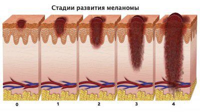 Стадии меланомы