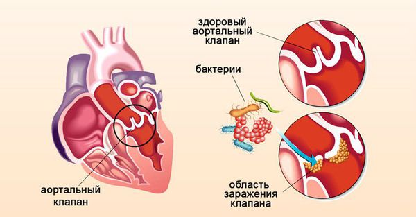 Эндокардит