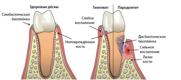 Пародонтит и гингивит